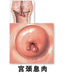 患了宫颈息肉还能怀孕吗
