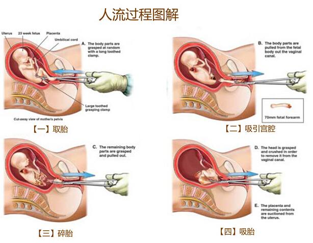 无痛人流到底是怎么来做的呢