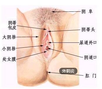 女性患外阴炎的原因